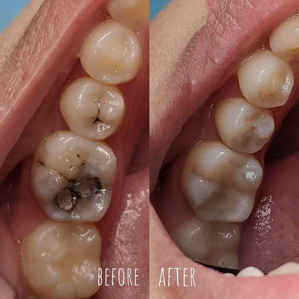 Dental Crown Before and After