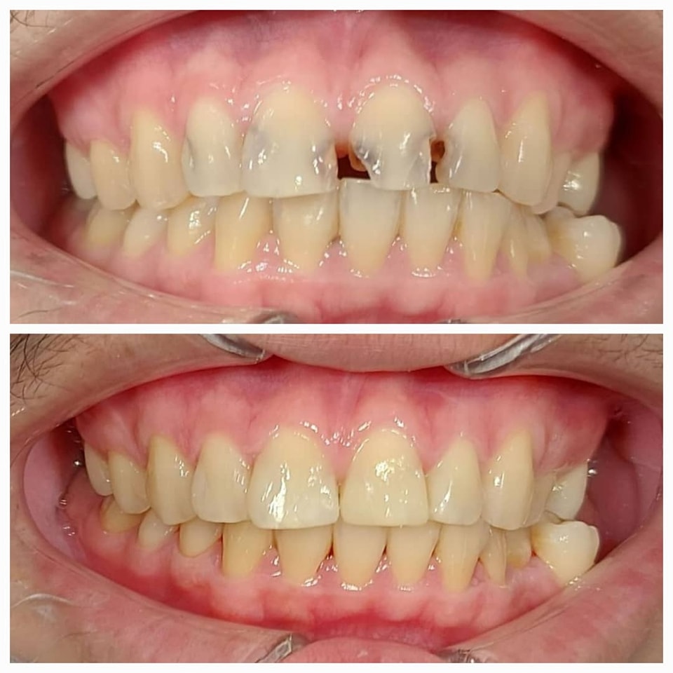Braces Treatment Before and After