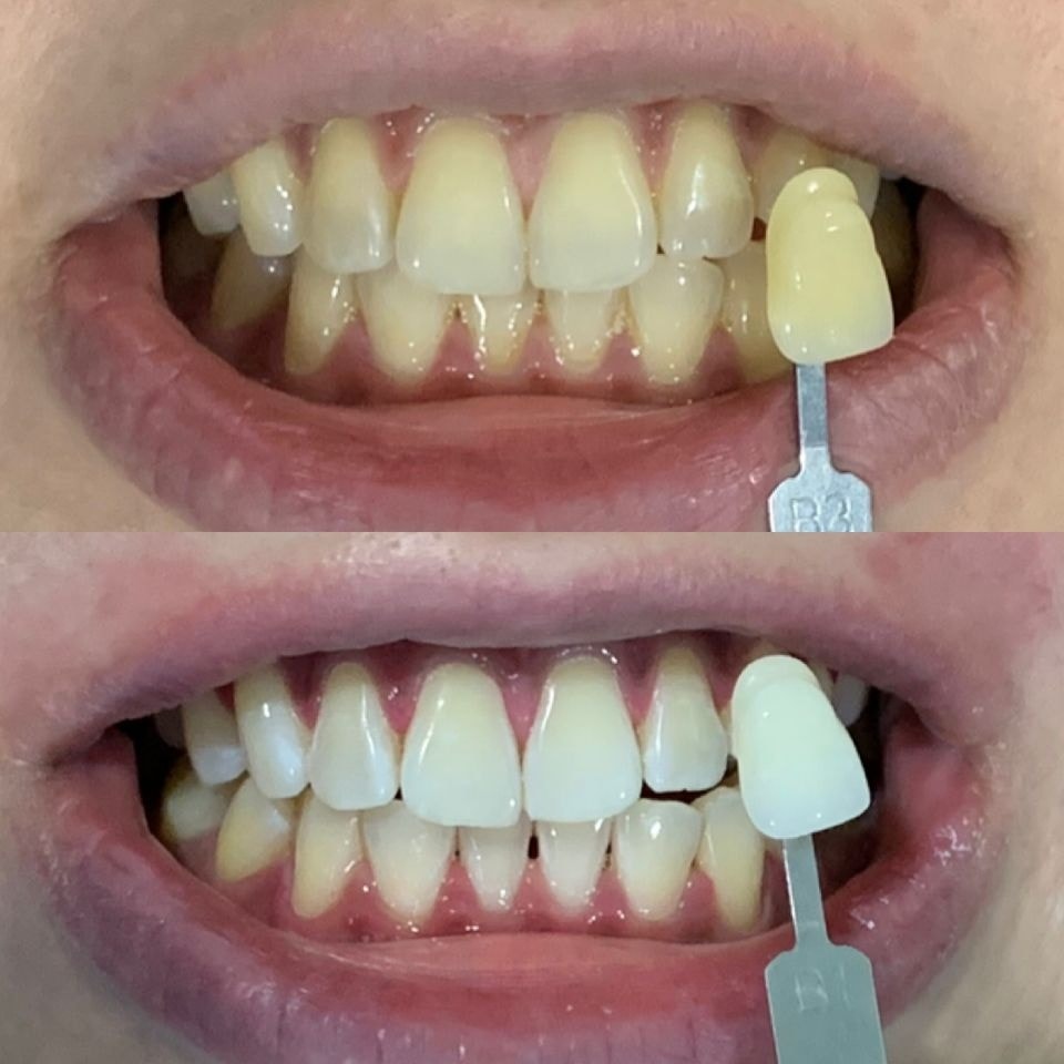 Dental Implant Before and After