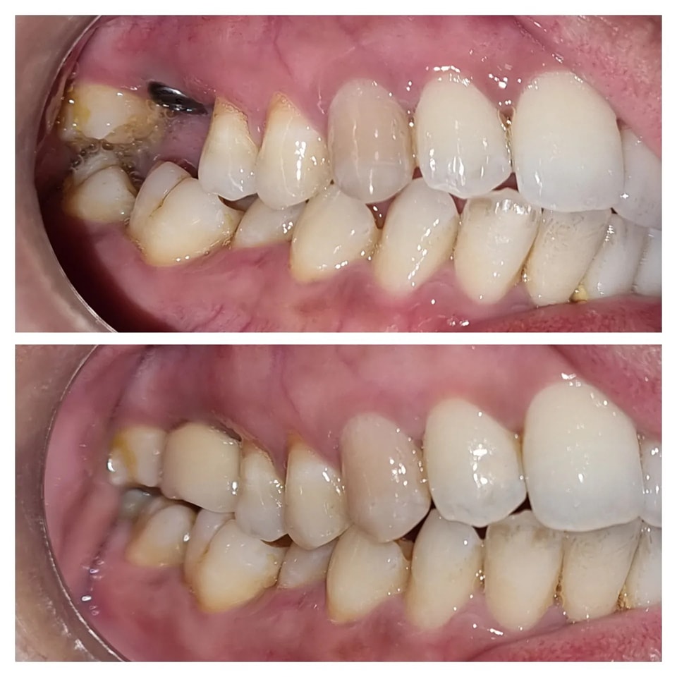 Whitening Results Before and After