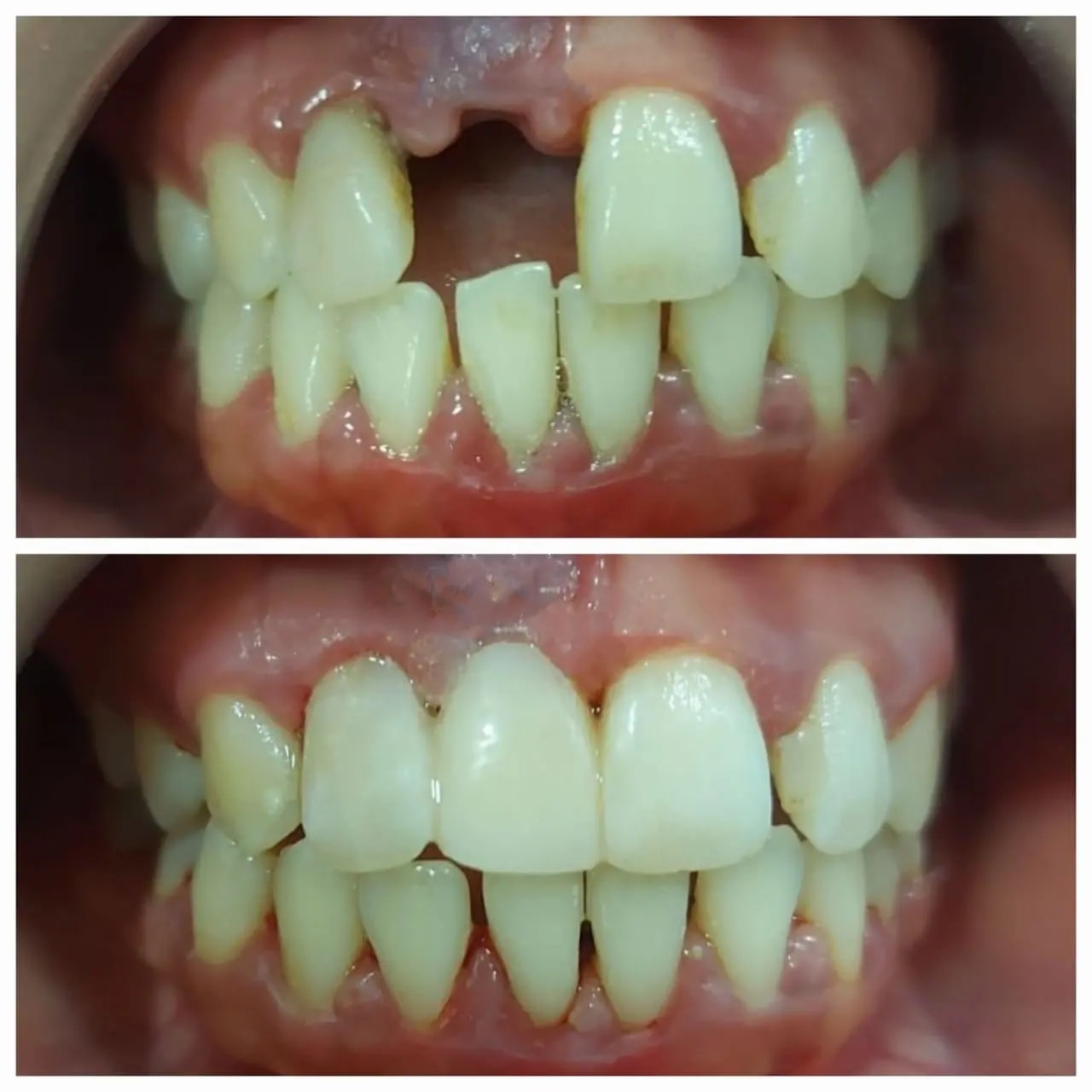 Tooth Restoration Before and After