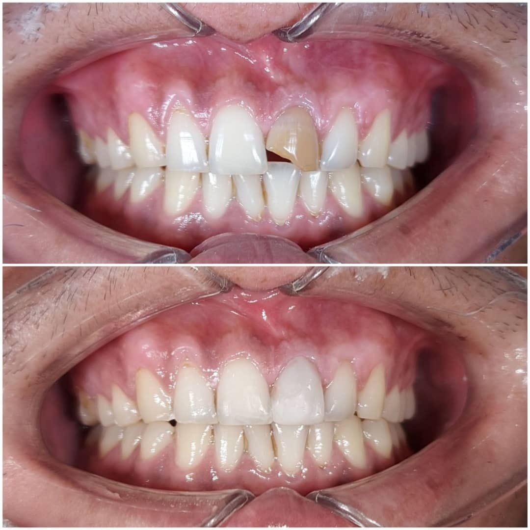 Amalgam Replacement Before and After