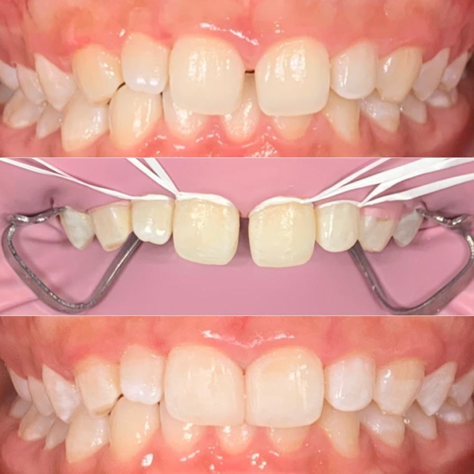 Teeth Whitening Before and After